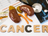 Stages of Kidney Cancer and its Treatment